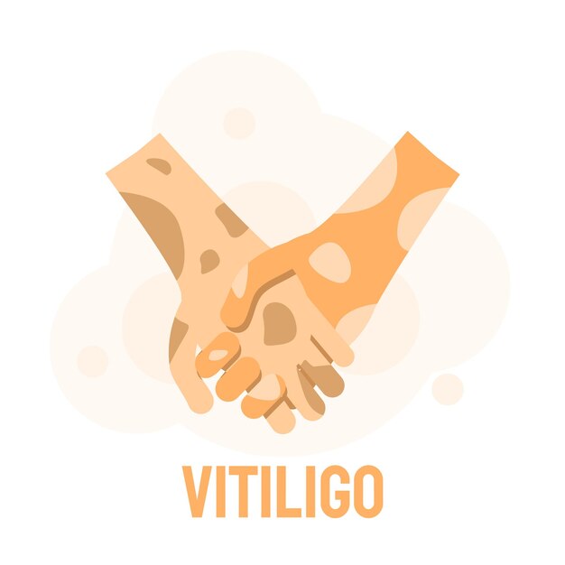 Support Temi's Vitiligo Journey